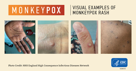 Monkeypox examples