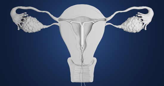 Pregnancy with an IUD is possible, and Roe overturn could make it